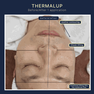 Thermal Up – RF Lifting & Sculpting System