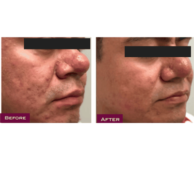 BDR - Rosa Calm - Capillary Relief Ampoule