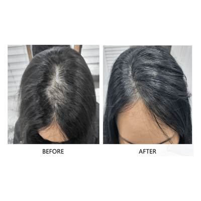 FollicleBoost ProFusion - (AP IIT 5ml x 5 + ISCE 2ml x 5 Combo Kit)