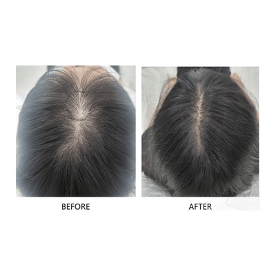 FollicleBoost ProFusion - (AP IIT 5ml x 5 + ISCE 2ml x 5 Combo Kit)