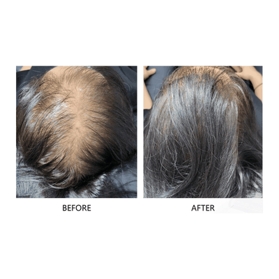 FollicleBoost ProFusion - (AP IIT 5ml x 5 + ISCE 2ml x 5 Combo Kit)