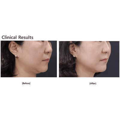 Microson Pen with Rubbing HIFU