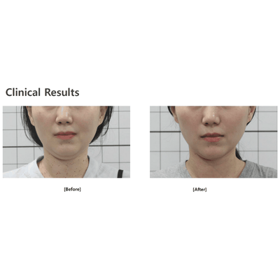 Microson Pen with Rubbing HIFU