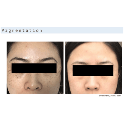 Cold Plasma Beauty Device - DR PLATON