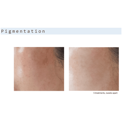 Cold Plasma Beauty Device - DR PLATON