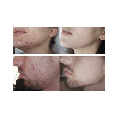 Cold Plasma Beauty Device - DR PLATON