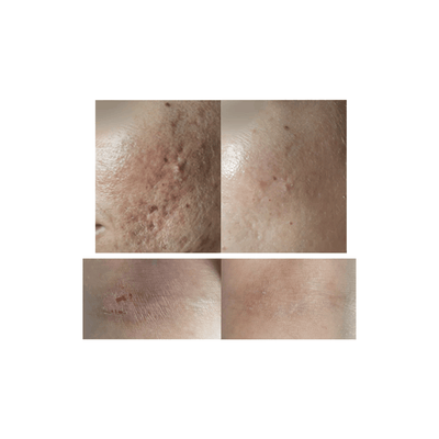 Cold Plasma Beauty Device - DR PLATON