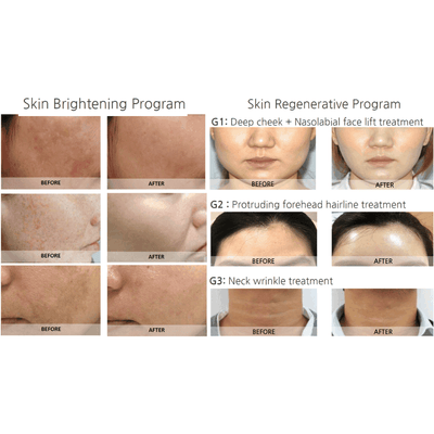 SYNA Needle-Free Injector