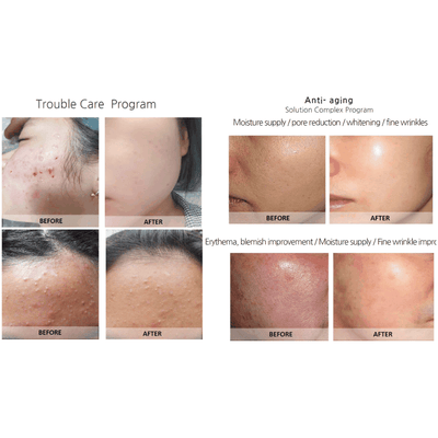 SYNA Needle-Free Injector