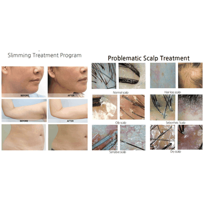 SYNA Needle-Free Injector