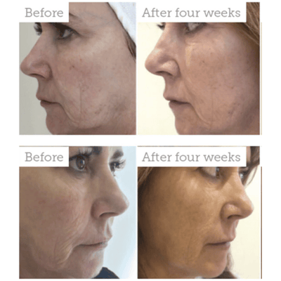 Rx Elysee Exosome Ampoule Combo (PDRN 4ml x 2 and P198 2ml x 2)