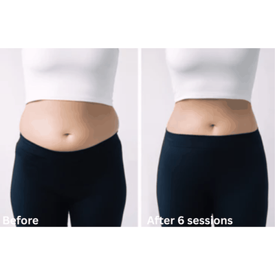 CELLTUNE ia-100RF: Professional Multipolar RF & Vacuum Body Contouring Therapy Device