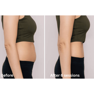 CELLTUNE ia-100RF: Professional Multipolar RF & Vacuum Body Contouring Therapy Device