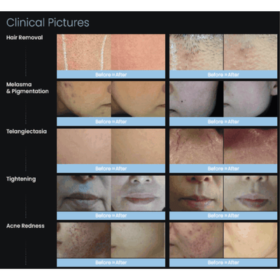 Nobleen Dual Long-Pulsed Alexandrite & Nd:YAG Laser