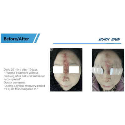 COLD PLASMA M ION TOUCH SYSTEM