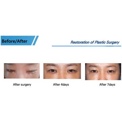 COLD PLASMA M ION TOUCH SYSTEM