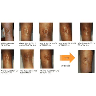 COLD PLASMA M ION TOUCH SYSTEM