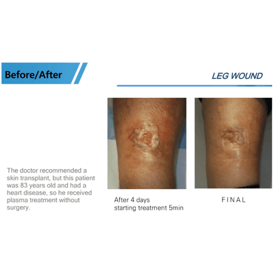 COLD PLASMA M ION TOUCH SYSTEM