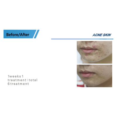 COLD PLASMA M ION TOUCH SYSTEM