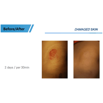 COLD PLASMA M ION TOUCH SYSTEM