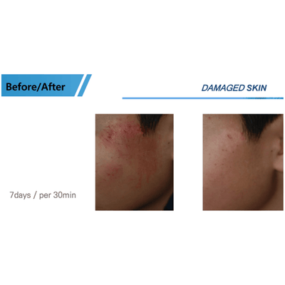 COLD PLASMA M ION TOUCH SYSTEM