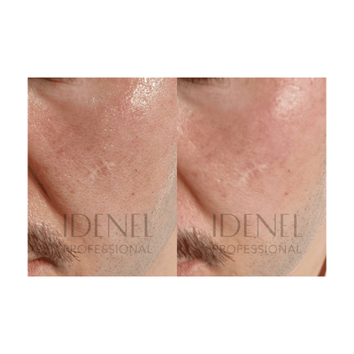 IDENEL - PEPTAXEL (Anti-aging "Purple" + Brightening "Yellow" Package: 10 Vials - 5 Vials of 1g + 5 Vials of 8ml)