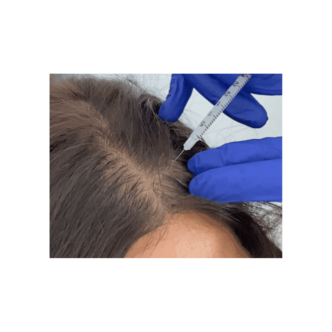 BallVic AP IIT Hair Gro Ampoule (5ml x 10ea)