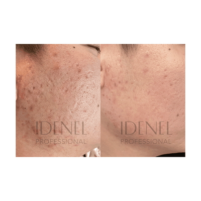 IDENEL - PEPTAXEL (Full Package: 20 Vials - 10 Vials of 1.5 g each + 10 Vials of 8ml each)