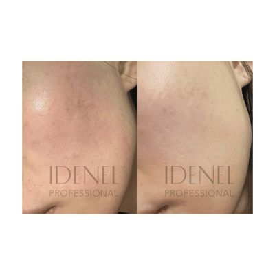 IDENEL - PEPTAXEL (Full Package: 20 Vials - 10 Vials of 1.5 g each + 10 Vials of 8ml each)