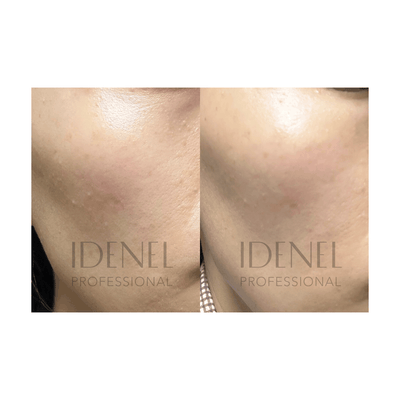 IDENEL - PEPTAXEL (Full Package: 20 Vials - 10 Vials of 1.5 g each + 10 Vials of 8ml each)