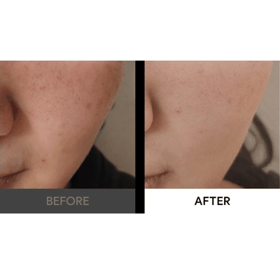 PRITTI - Cold Plasma Handheld Device