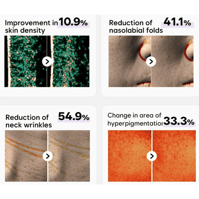 PRITTI - Cold Plasma Handheld Device