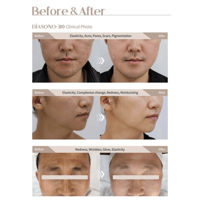 Professional Spa Machine - Diasono 310 - Dermafirm USA