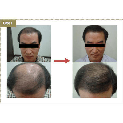 BallVic AP IIT Ampoule - 10 x 5ml - Dermafirm USA