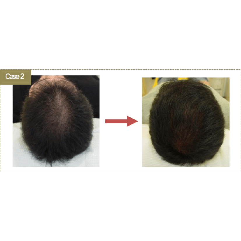 BallVic AP IIT Ampoule - 10 x 5ml - Dermafirm USA