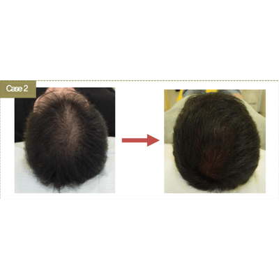 BallVic AP IIT Ampoule - 10 x 5ml - Dermafirm USA