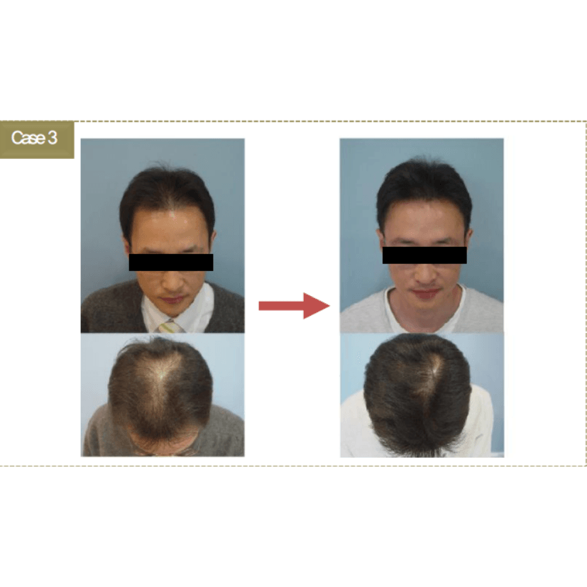 BallVic AP IIT Ampoule - 10 x 5ml - Dermafirm USA