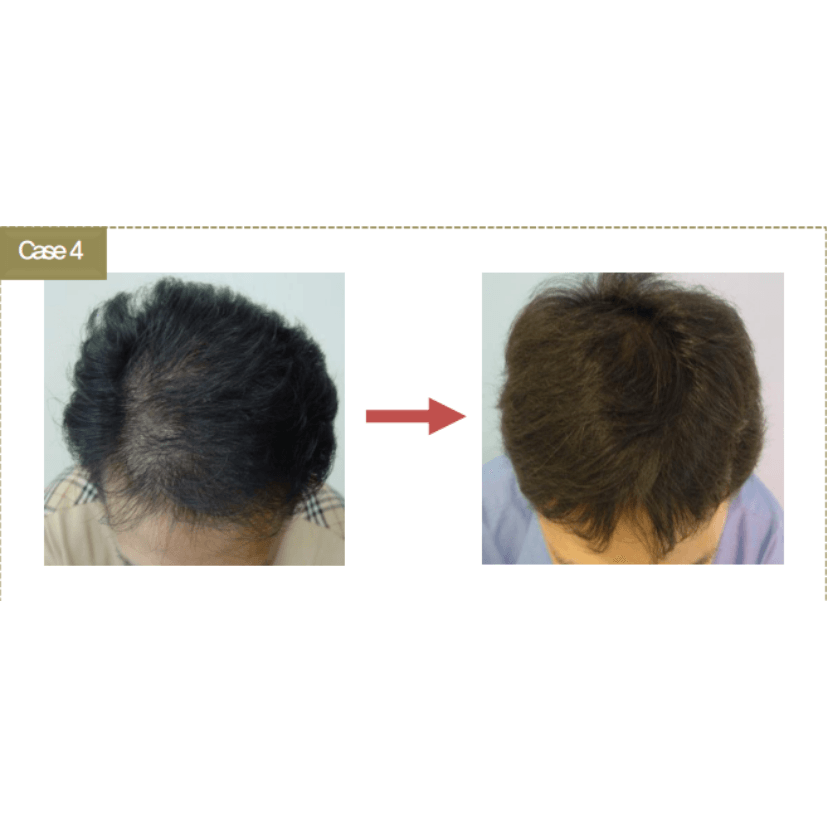 BallVic AP IIT Ampoule - 10 x 5ml - Dermafirm USA