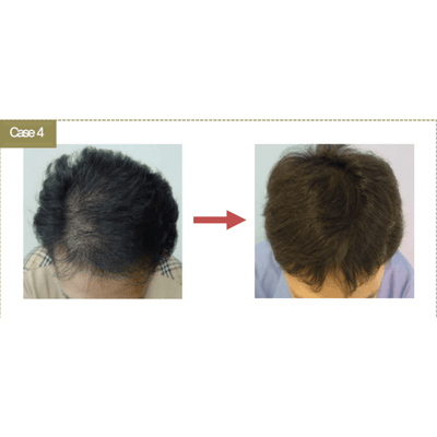 BallVic AP IIT Ampoule - 10 x 5ml - Dermafirm USA