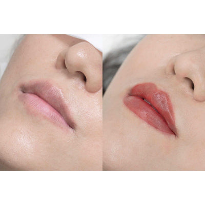 Staccato - Scalp Micropigmentation (SMP) Machine - Dermafirm USA