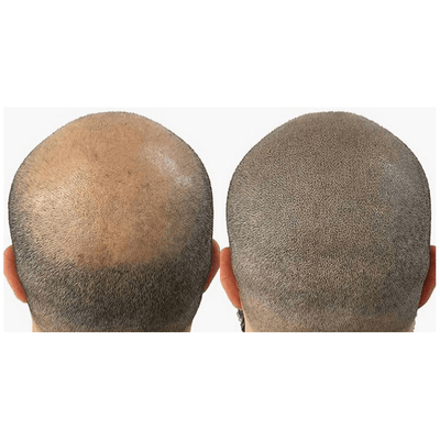 Staccato - Scalp Micropigmentation (SMP) Machine - Dermafirm USA