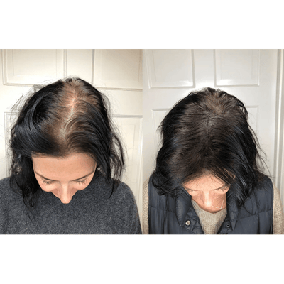 Staccato - Scalp Micropigmentation (SMP) Machine - Dermafirm USA