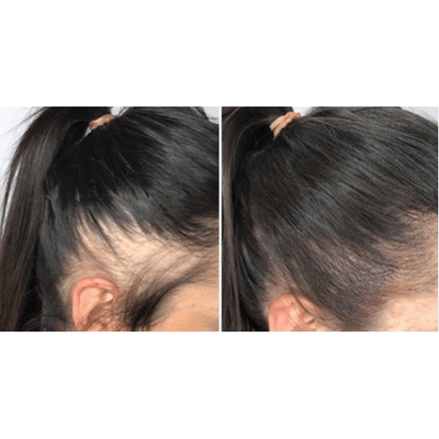 Staccato - Scalp Micropigmentation (SMP) Machine - Dermafirm USA