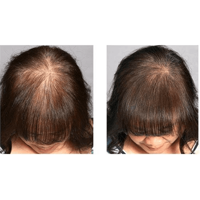 Staccato - Scalp Micropigmentation (SMP) Machine - Dermafirm USA