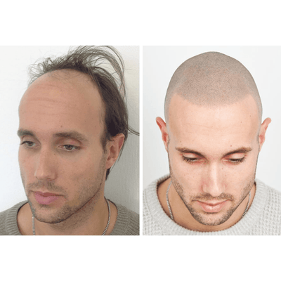 Staccato - Scalp Micropigmentation (SMP) Machine - Dermafirm USA
