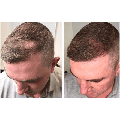 Staccato - Scalp Micropigmentation (SMP) Machine - Dermafirm USA