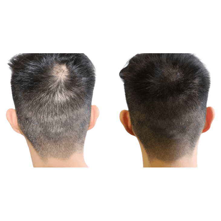 Staccato - Scalp Micropigmentation (SMP) Machine - Dermafirm USA