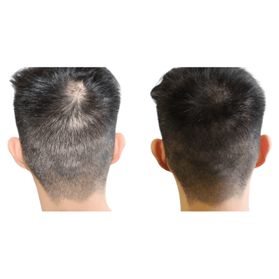 Staccato - Scalp Micropigmentation (SMP) Machine - Dermafirm USA