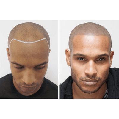 Staccato - Scalp Micropigmentation (SMP) Machine - Dermafirm USA