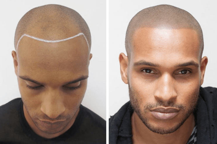 Scalp Micro Pigmentation Made Easy with Staccato - Dermafirm USA